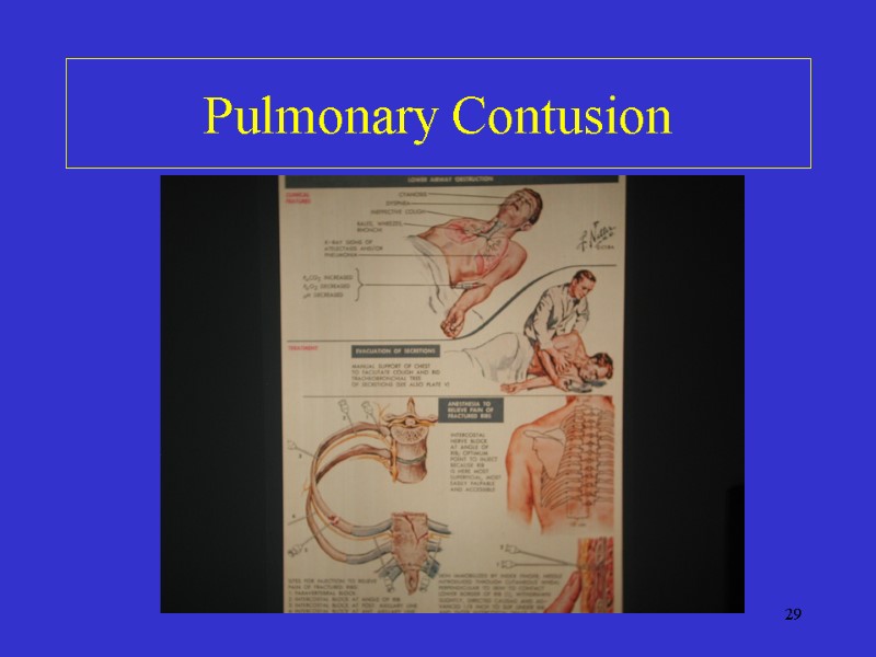 29 Pulmonary Contusion